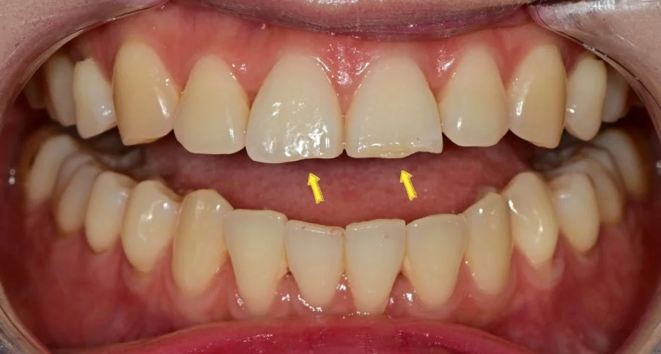 앞니 파절 치료 전 구내사진 화살표 표시 Case1