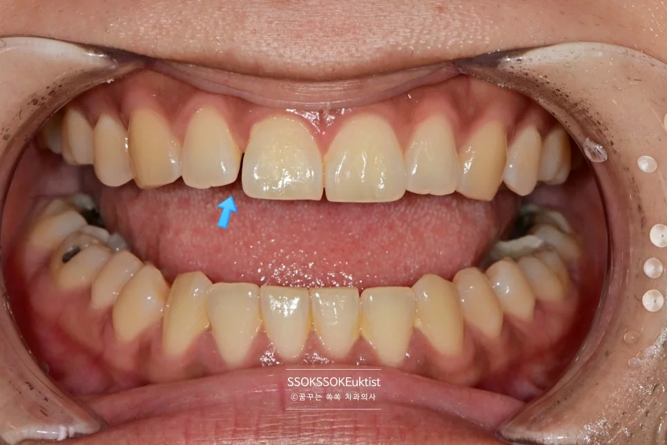 앞니 벌어짐 교합 확인 구내사진 화살표