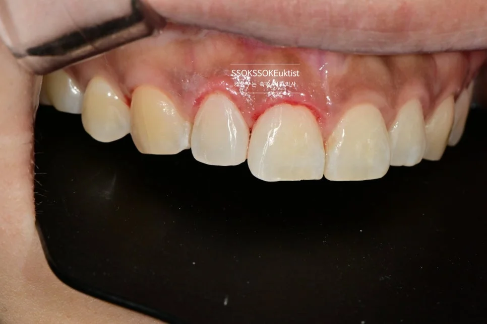 앞니 벌어짐 측면 레진 치료 후 사진