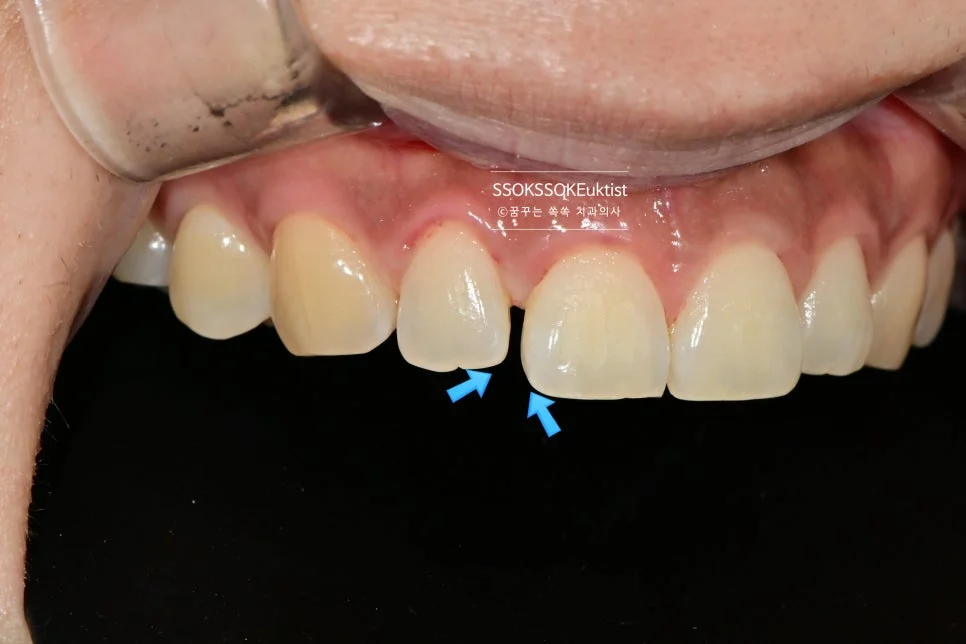 앞니 벌어짐 측면 치료 전 구내사진