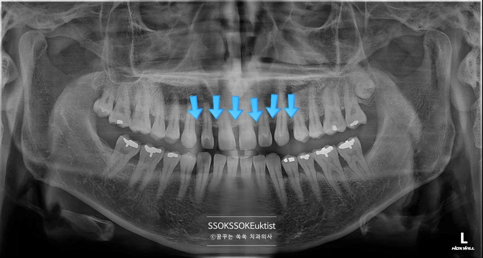 앞니 벌어짐 파노라마 엑스레이 진단