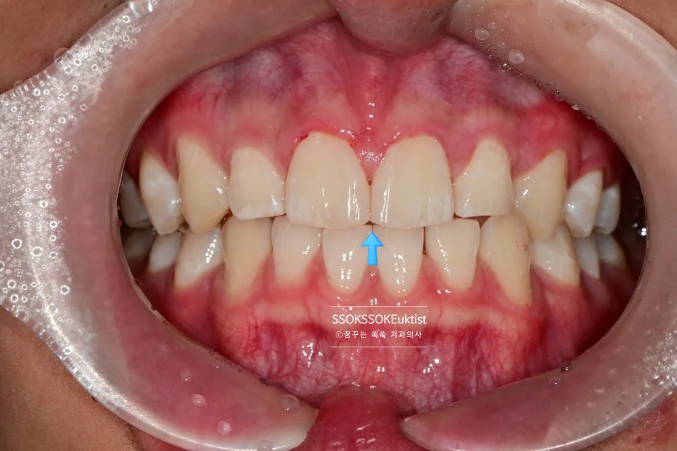 앞니 벌어짐 레진 치료 직후 정면 사진