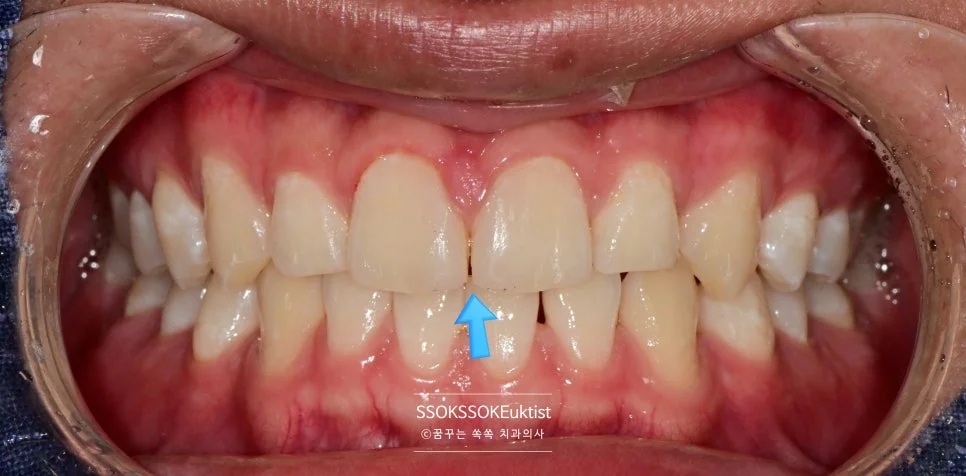 앞니 레진 치료 10개월 후 경과 사진