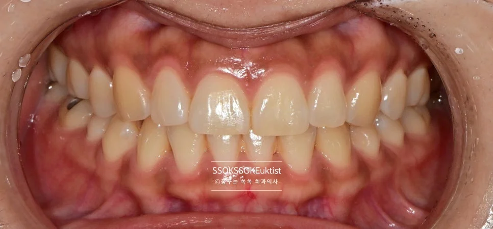 앞니 레진 치료 1개월 후 정면 경과 사진
