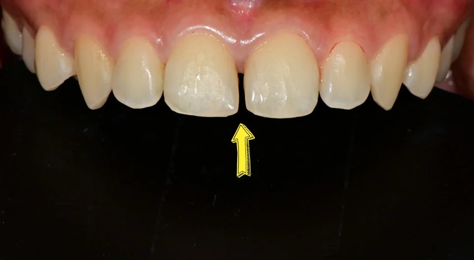 심한 다이아스테마 변색 레진 치료 전 화살표 표시 Case4