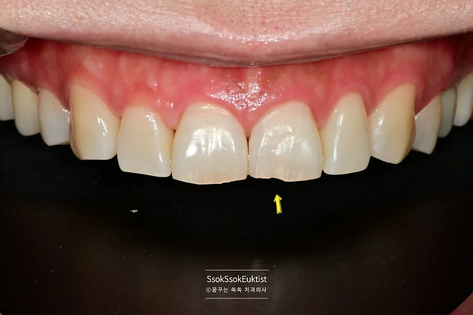 앞니 파절 치료 전 사진