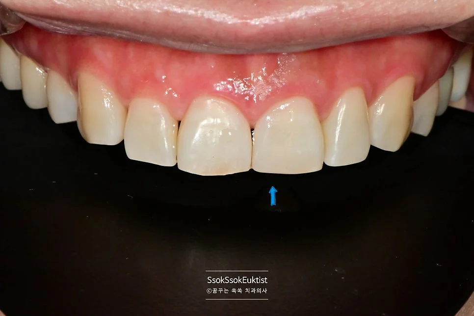 앞니 파절 레진 수복 후 사진