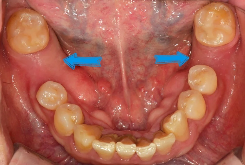 상하악 전체 구강 진단 사진 임플란트 필요 부위