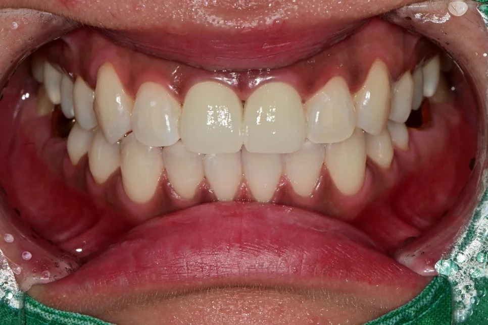 전악 미백 3사이클 완료 후 최종 스마일 결과