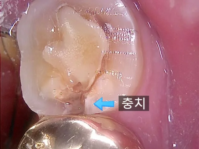 금니 크라운 제거 후 노출된 치아 사이 충치