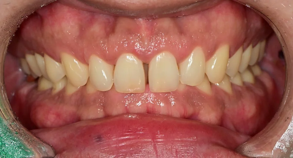 잇몸 치료 후 상태 1