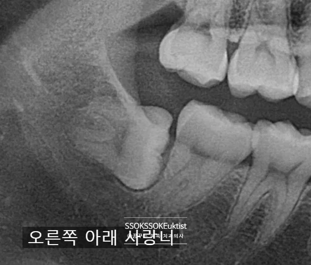 수평 매복 사랑니 치근단 엑스레이