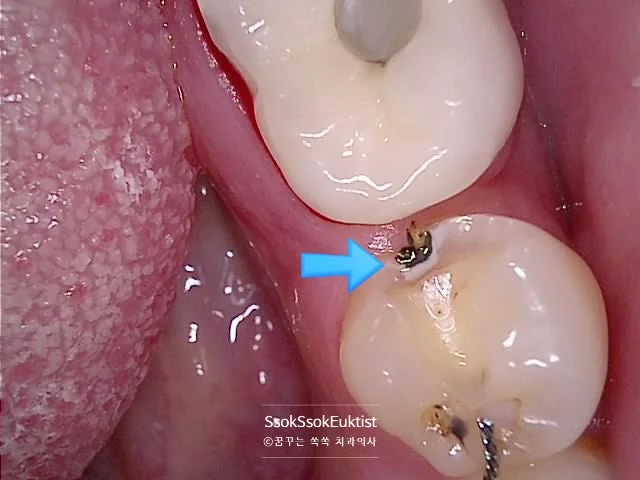 임플란트 인접 충치 인레이 치료