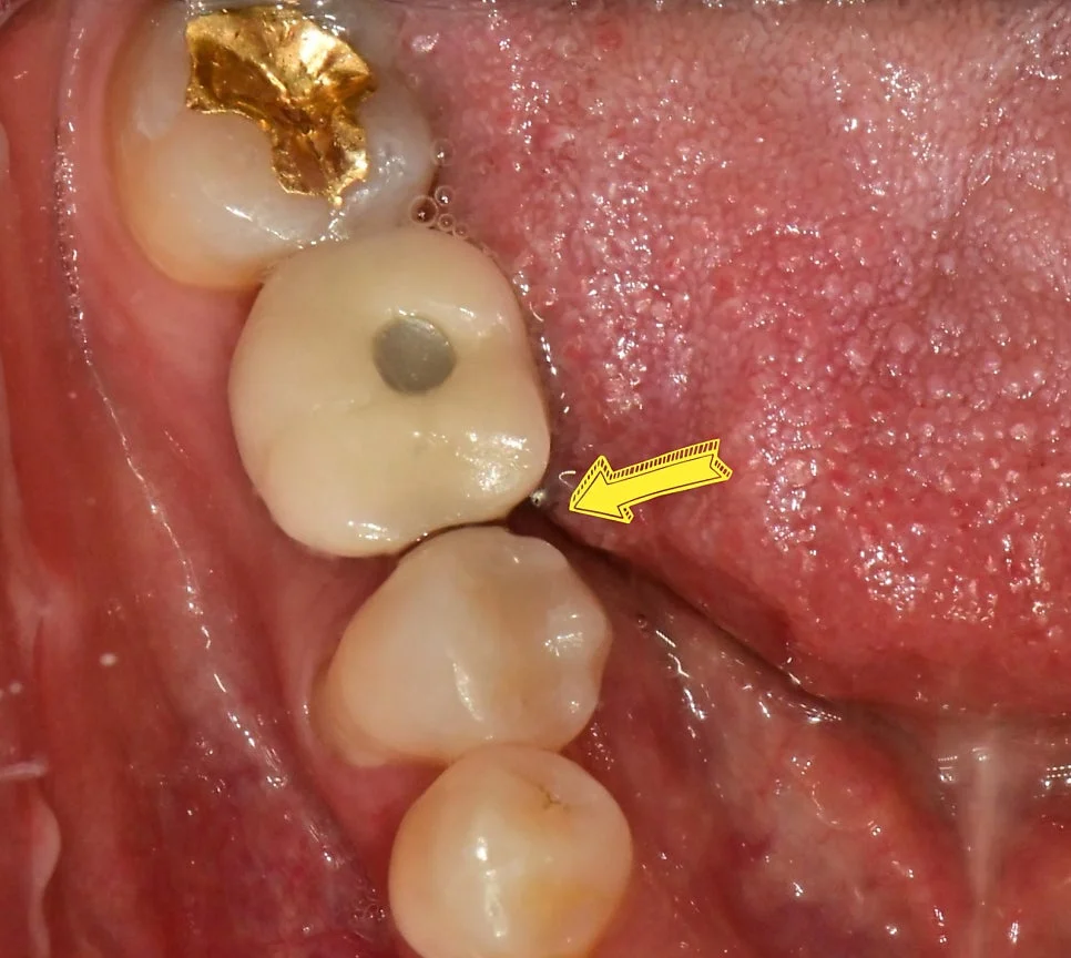 임플란트와 자연치아 사이 벌어진 틈 임상 사진