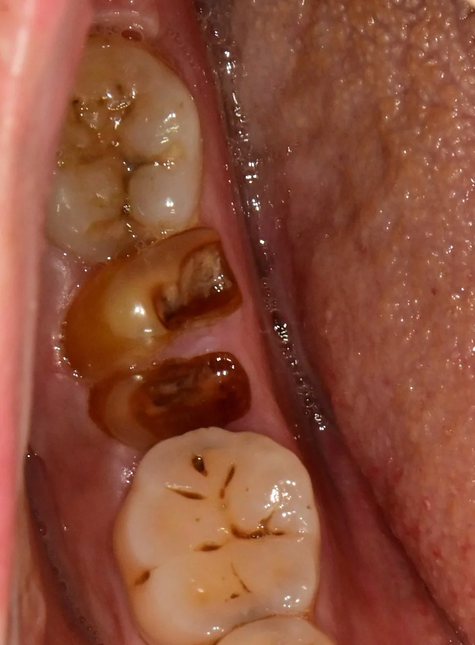 임플란트 수술 전 하악 치아 근접 진단 사진