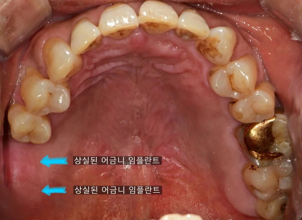 임플란트 뼈이식 재료 배치 수술 사진