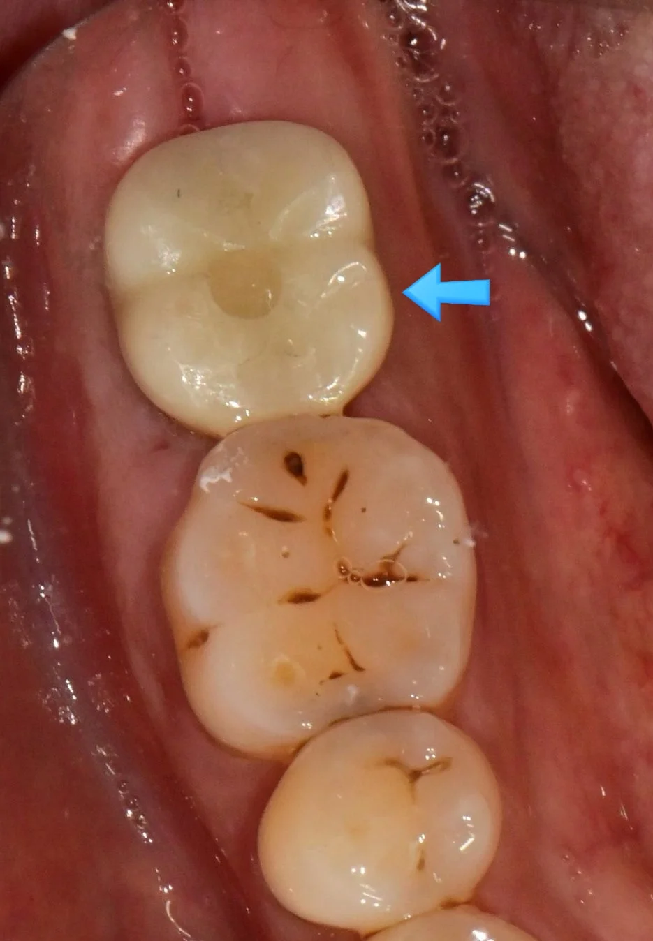 임플란트 수술 후 초기 치유 단계 파란 화살표 표시