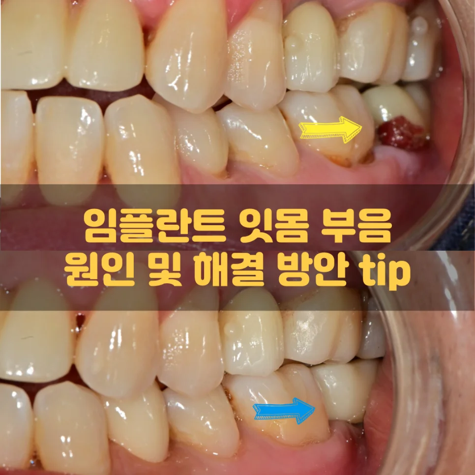 임플란트 잇몸 부음 원인 설명 일러스트