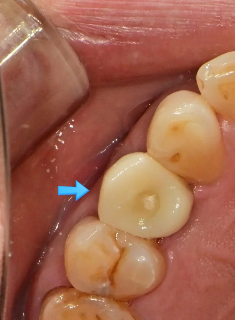 임플란트 수술 후 회복 완료 상태 파란 화살표 표시