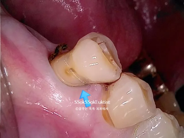 임플란트 골유합 확인 임상 사진