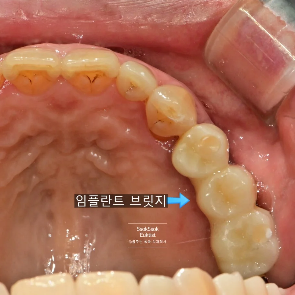 임플란트 보철물 장착 전 최종 확인 사진