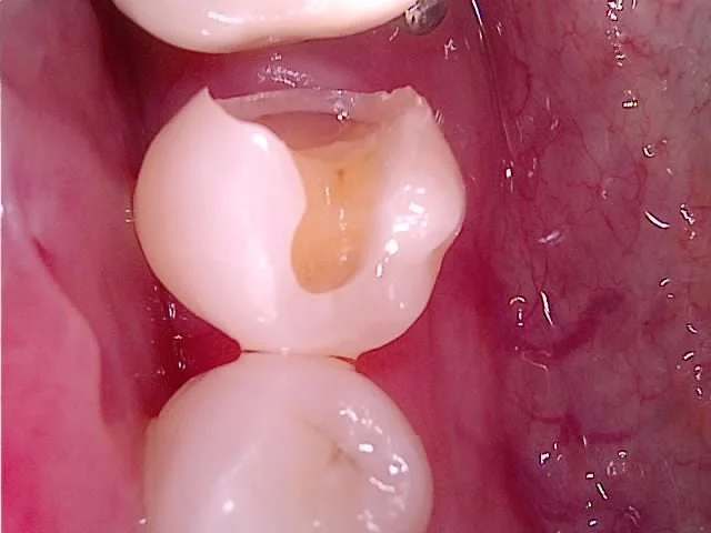 인레이 본 채득 후 임시 재료 수복 사진
