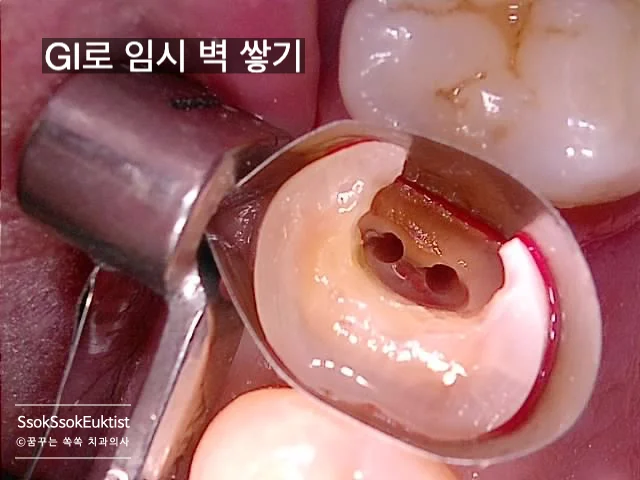 신경관 내 감염 조직 제거 과정 임상 사진