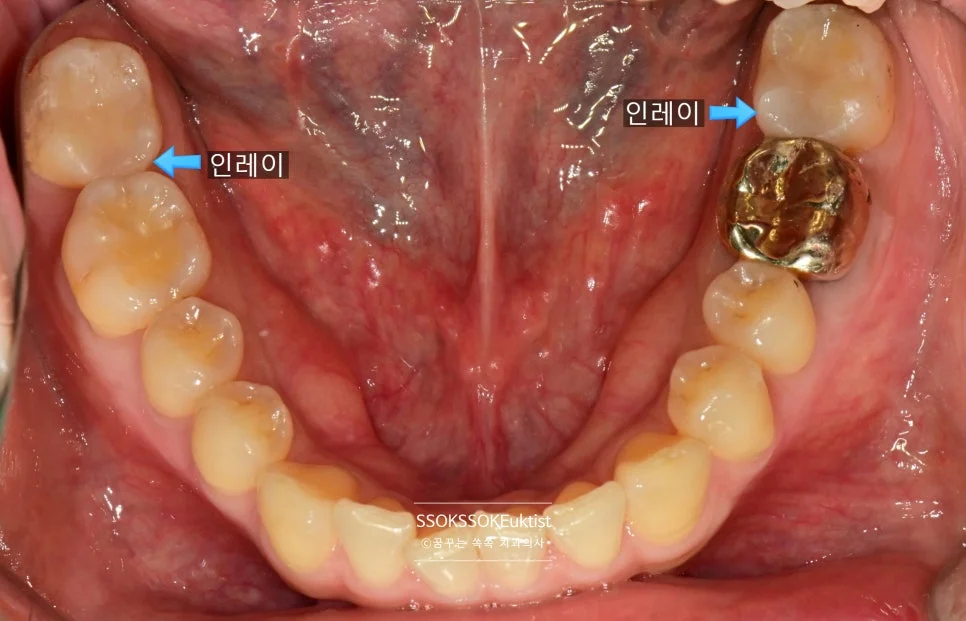 인레이 치료 후 하악 교합면 양측 인레이 완료