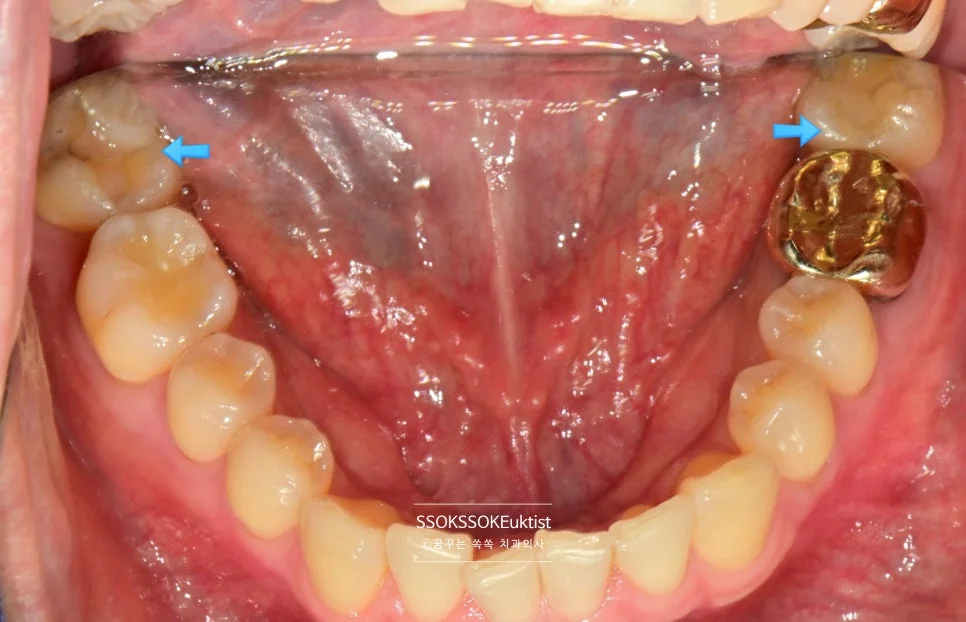 인레이 치료 전 하악 교합면 양측 충치 표시