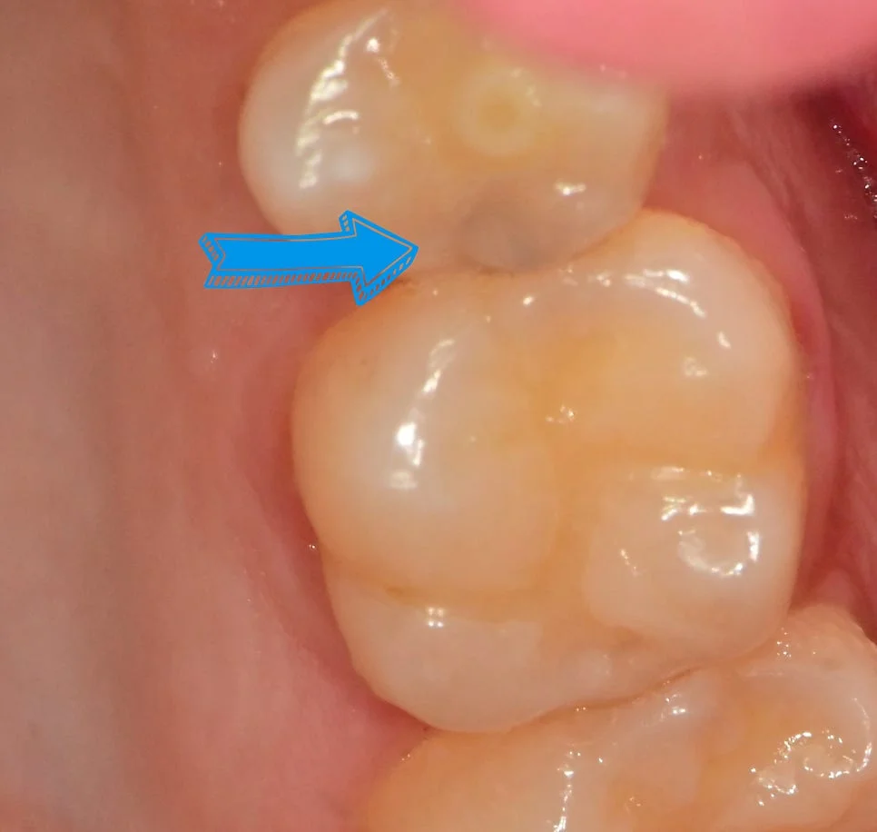 인레이 충치 치료 전 구강 사진 화살표 표시