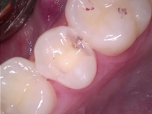 치아 삭제 후 큰 충치 노출 구강 사진