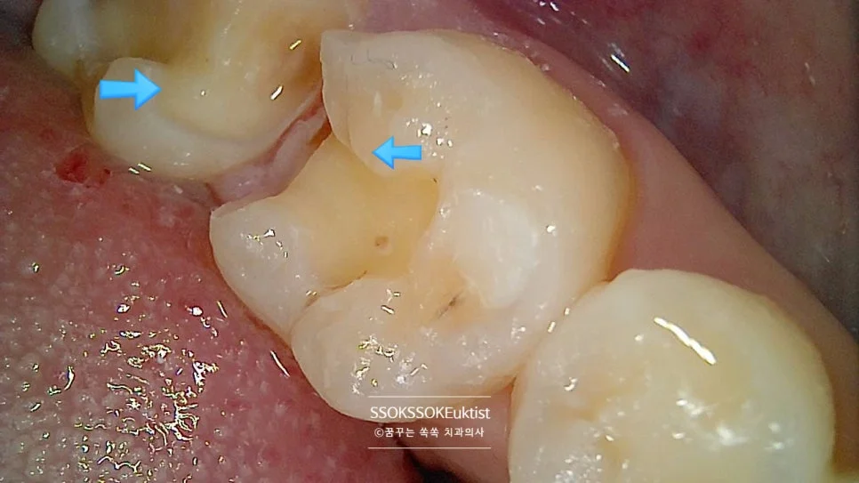 인레이 와동 형성 충치 완전 제거
