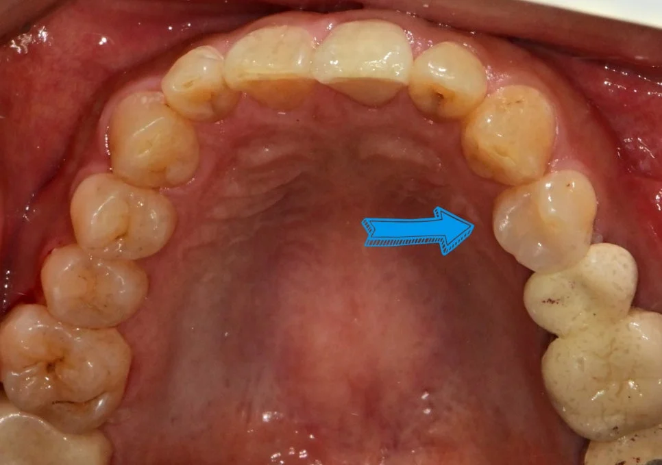 인레이 양쪽 치아 적합성 확인