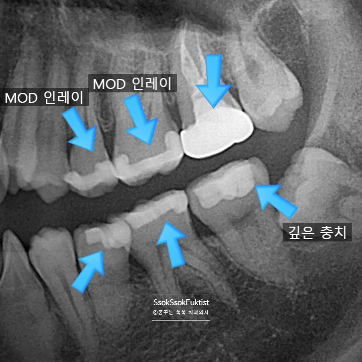 인레이 크라운 방사선 분석