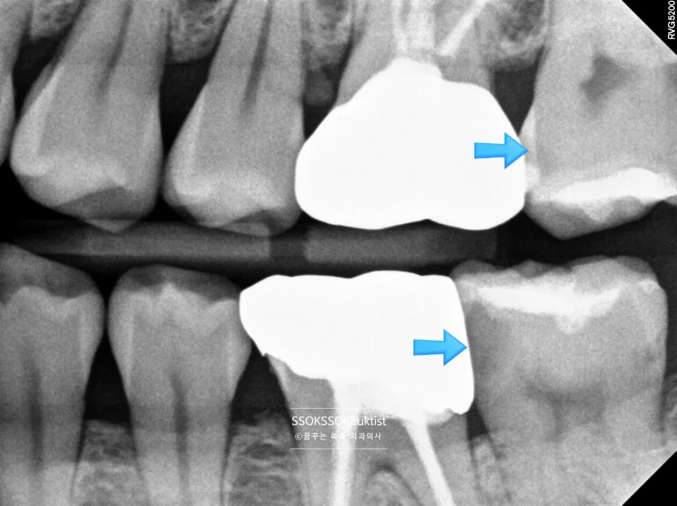 인레이 충치 진단 좌측 치근단 X-ray 보철물 주변 충치