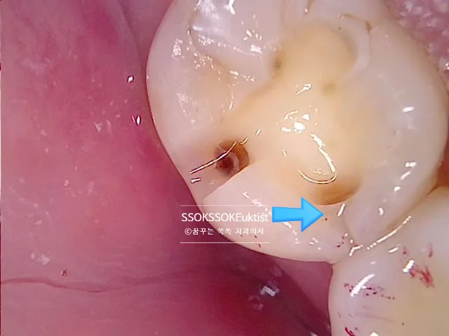 인레이 치료 중 발견된 숨은 인접면 충치