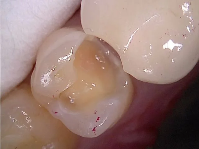 인레이 인상 채득 임시충전