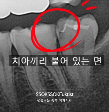 인레이 인접면 충치 엑스레이 진단