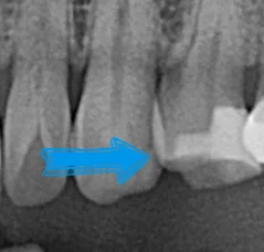 인레이 세팅 완료