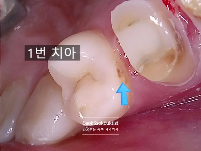 인접면 충치 화살표 표시 1