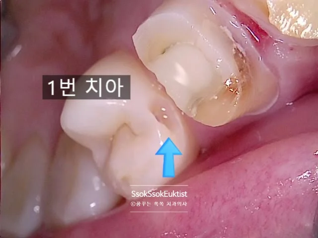 인접면 충치 화살표 표시 2