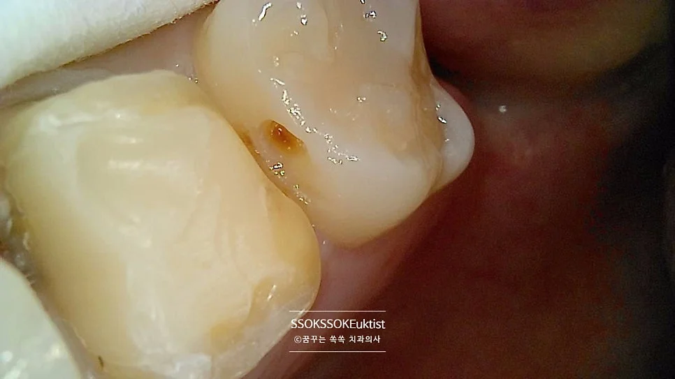 인접면 충치 교합면 치료 전