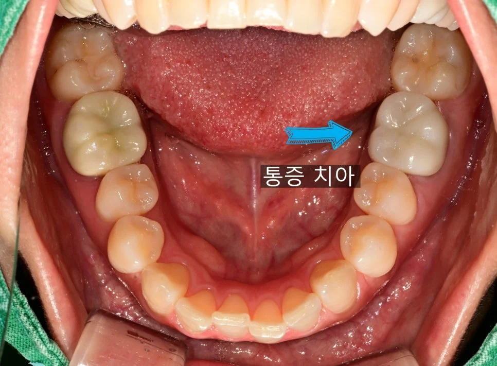 구강 내 통증 치아 위치 화살표 표시 임상 사진