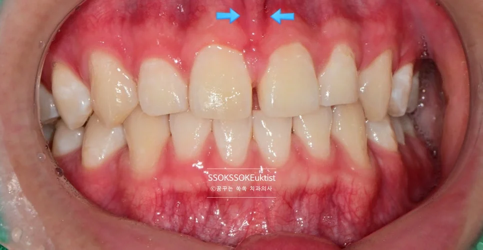 순소대 부착 위치 화살표 표시 구내 사진