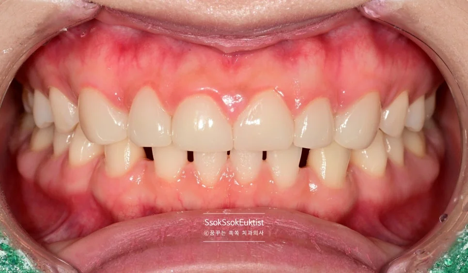 라미네이트 3개월 후 경과 정면