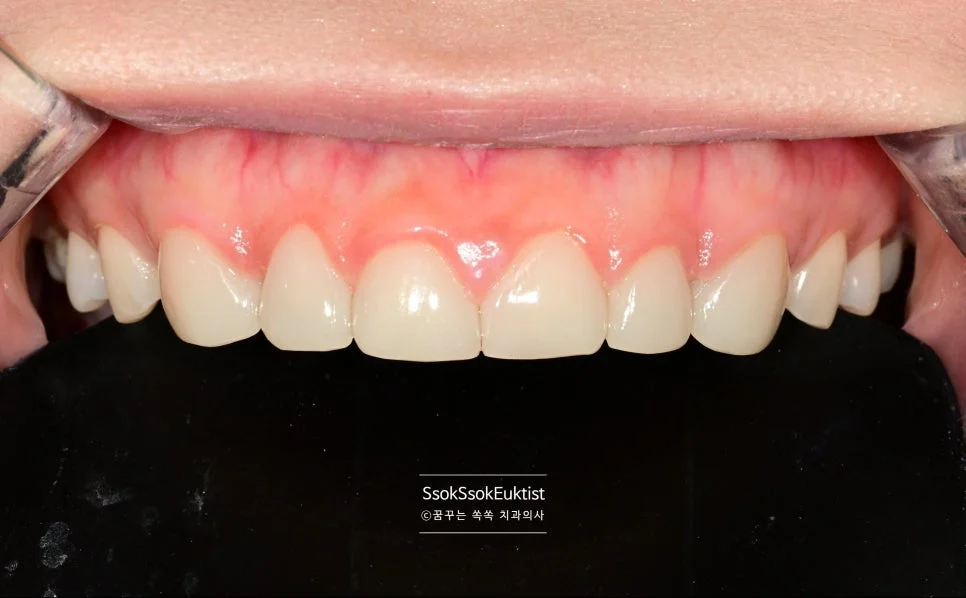 라미네이트 3개월 후 미소 사진