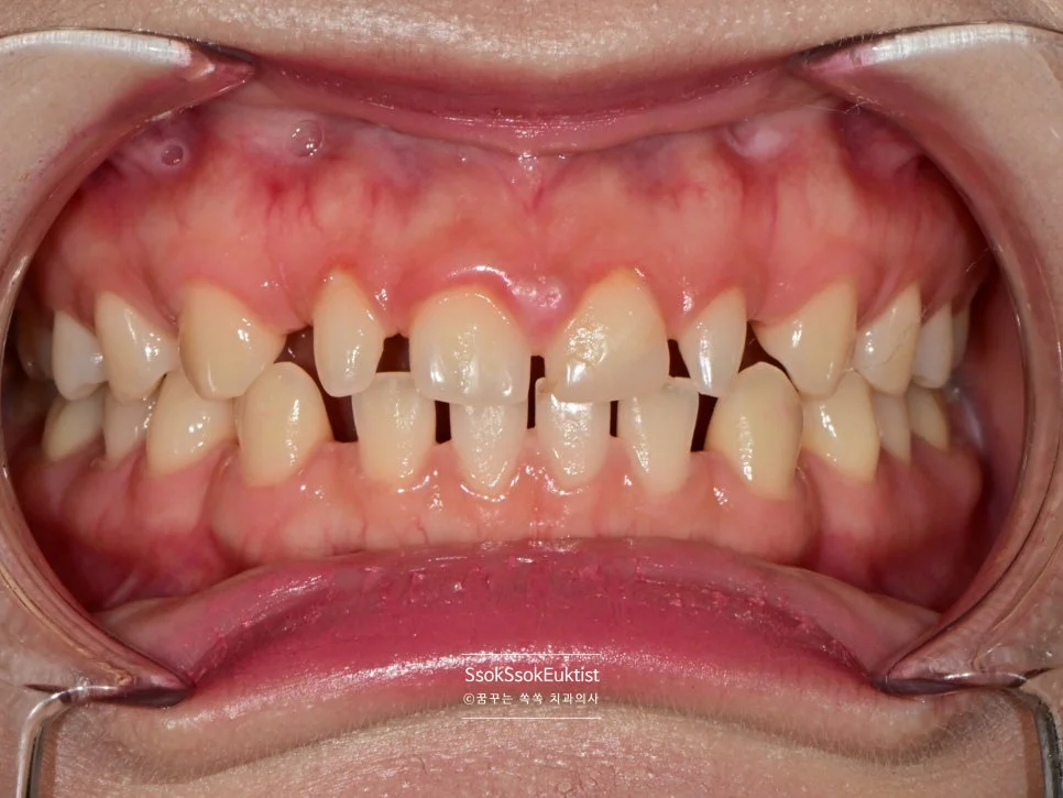 라미네이트 전 개구 상태 치아 사이 공간