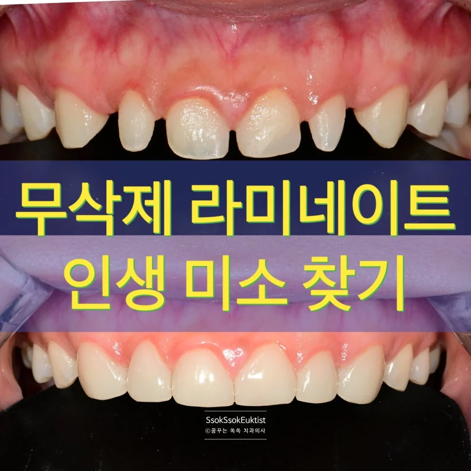 라미네이트 전 작은 앞니 미소 사진