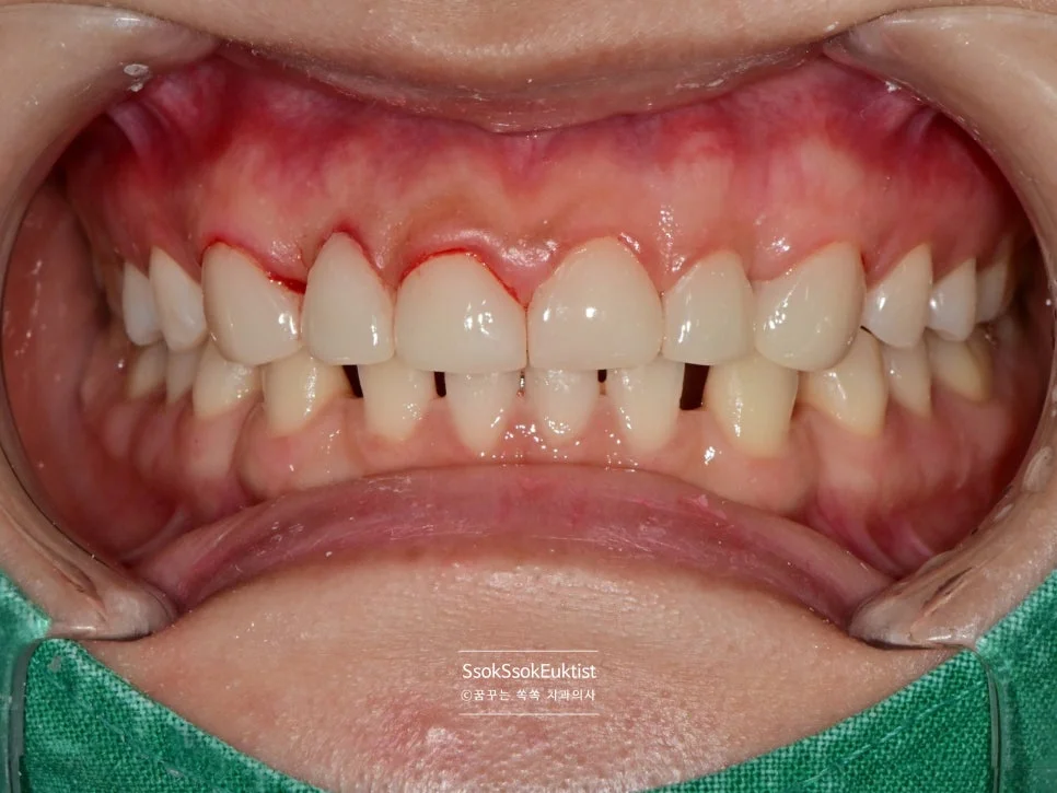 재작업 후 최종 라미네이트 완성