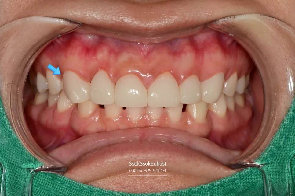 1차 라미네이트 결과 약간 긴 형태